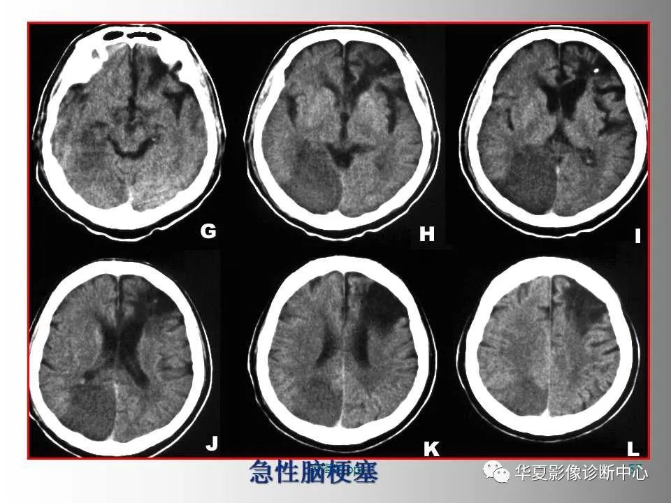 影像PPT - 【PPT】脑卒中影像诊断-56