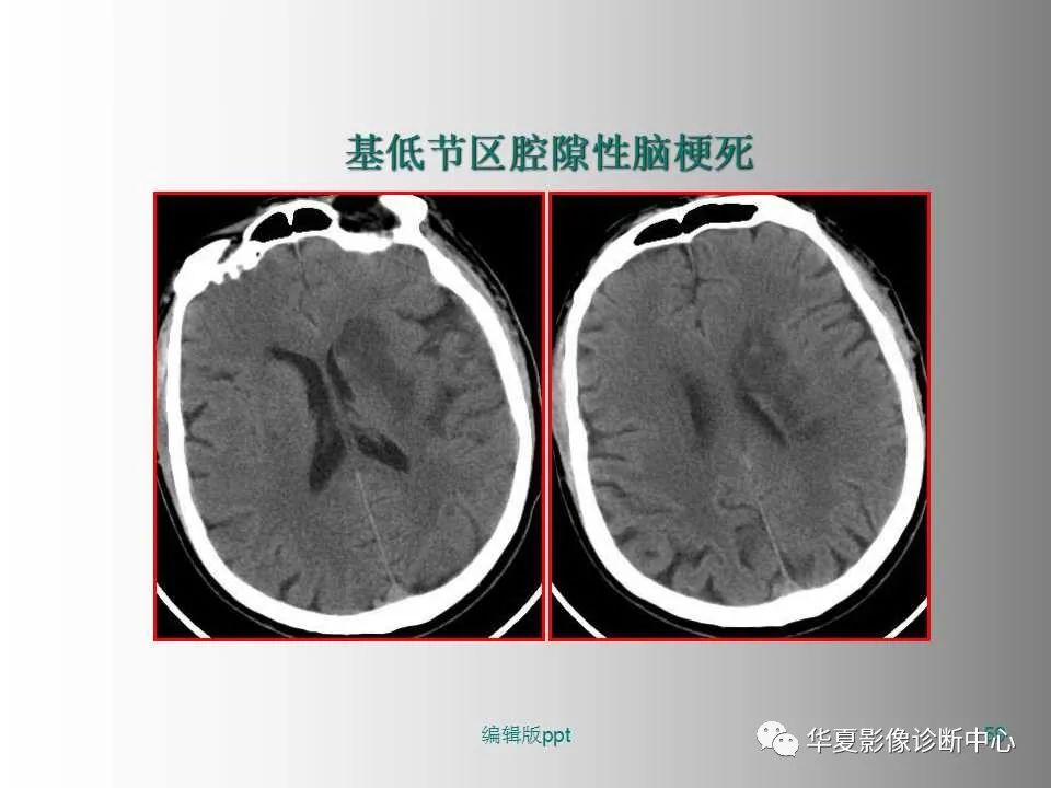 影像PPT - 【PPT】脑卒中影像诊断-58