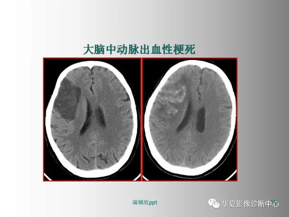 影像PPT - 【PPT】脑卒中影像诊断-54