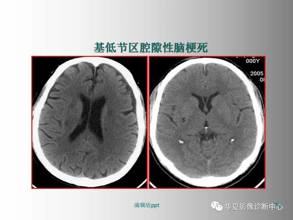 影像PPT - 【PPT】脑卒中影像诊断-59