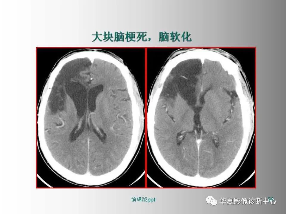 影像PPT - 【PPT】脑卒中影像诊断-55