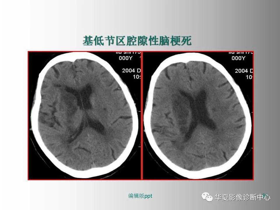 影像PPT - 【PPT】脑卒中影像诊断-60
