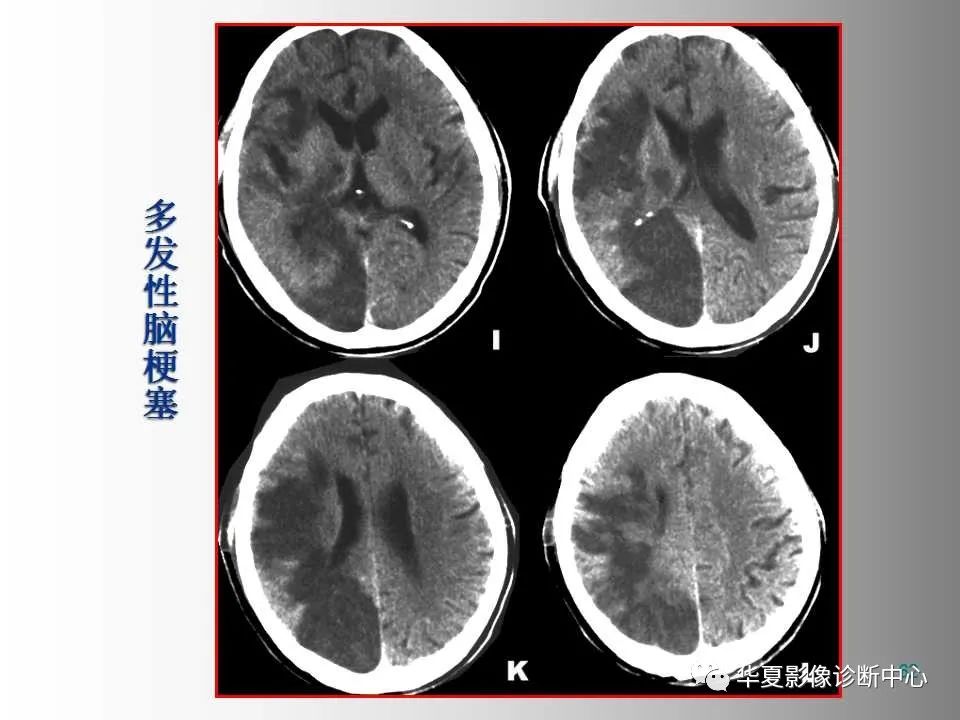 影像PPT - 【PPT】脑卒中影像诊断-61