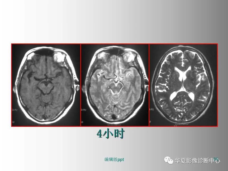 影像PPT - 【PPT】脑卒中影像诊断-67
