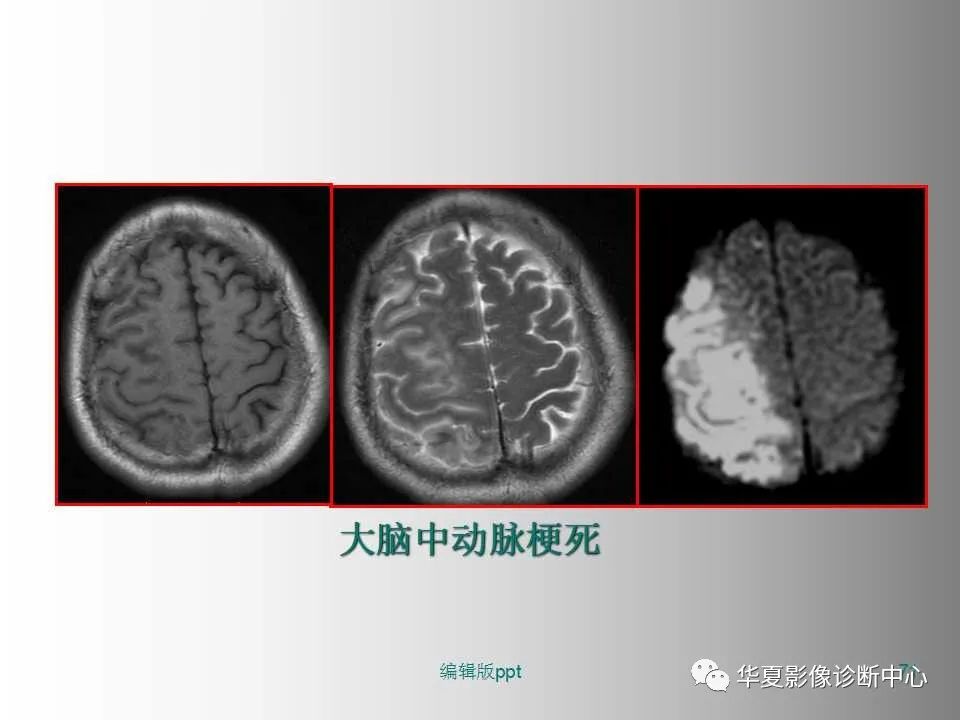 影像PPT - 【PPT】脑卒中影像诊断-70