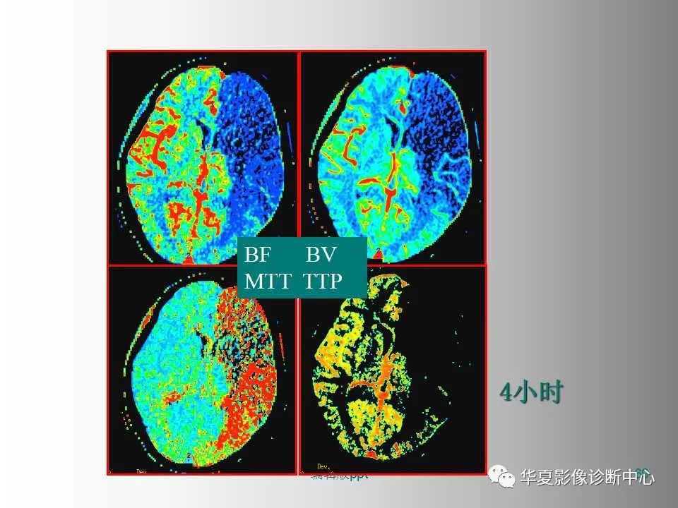 影像PPT - 【PPT】脑卒中影像诊断-68