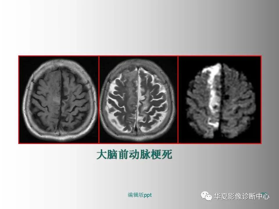 影像PPT - 【PPT】脑卒中影像诊断-71