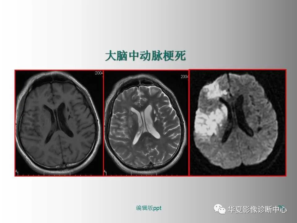 影像PPT - 【PPT】脑卒中影像诊断-69