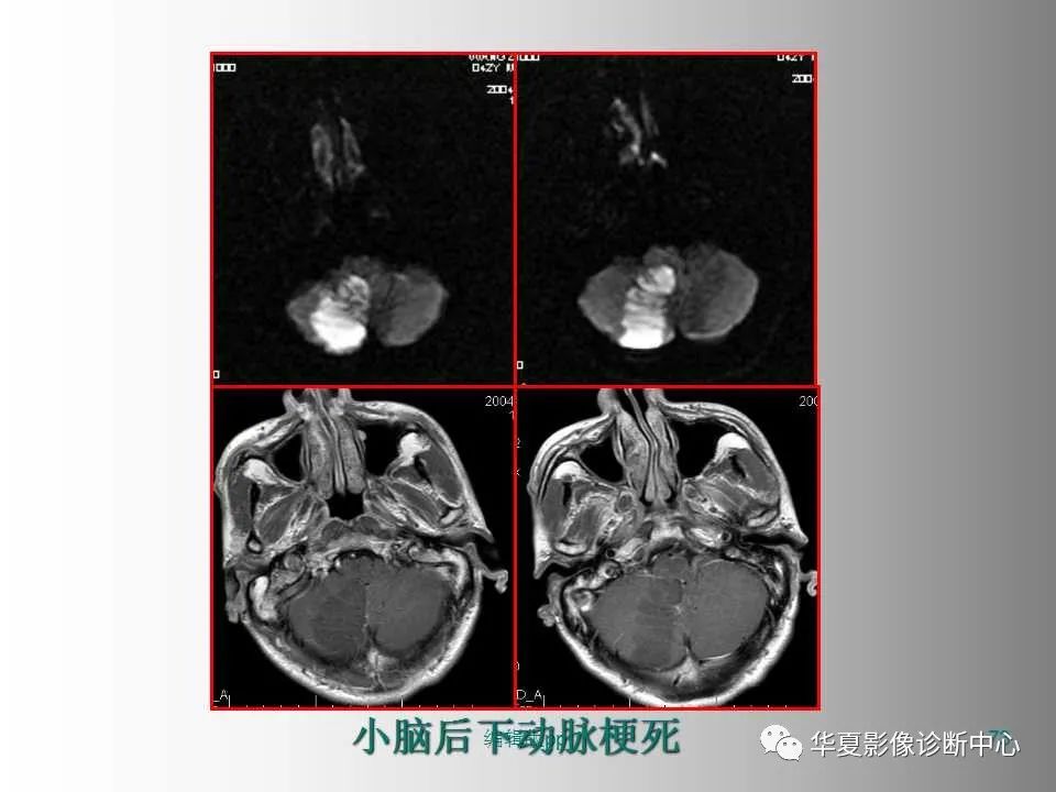 影像PPT - 【PPT】脑卒中影像诊断-72