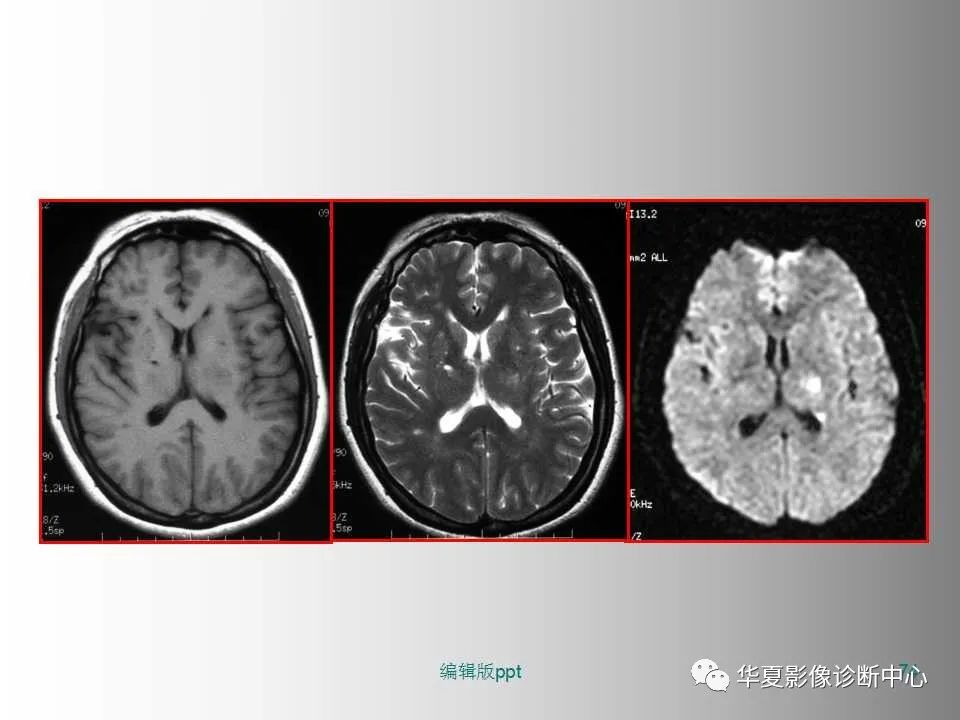 影像PPT - 【PPT】脑卒中影像诊断-73