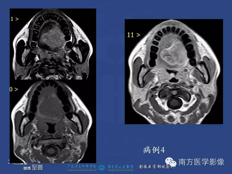 影像PPT - 【PPT】舌良、恶性肿瘤MR鉴别诊断-5