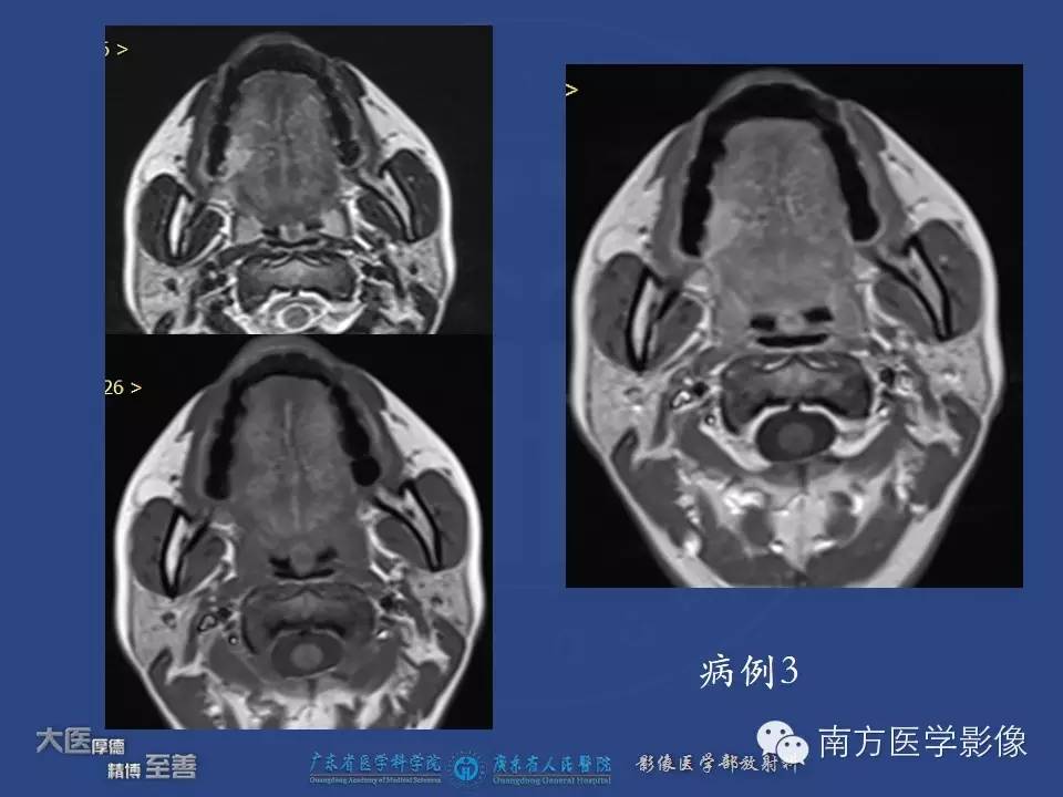 影像PPT - 【PPT】舌良、恶性肿瘤MR鉴别诊断-4