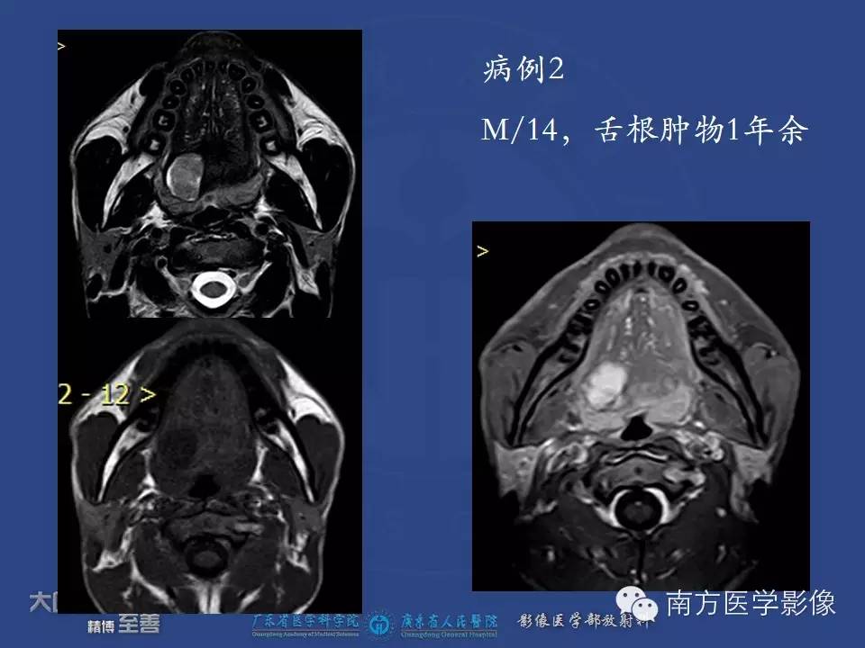 影像PPT - 【PPT】舌良、恶性肿瘤MR鉴别诊断-3