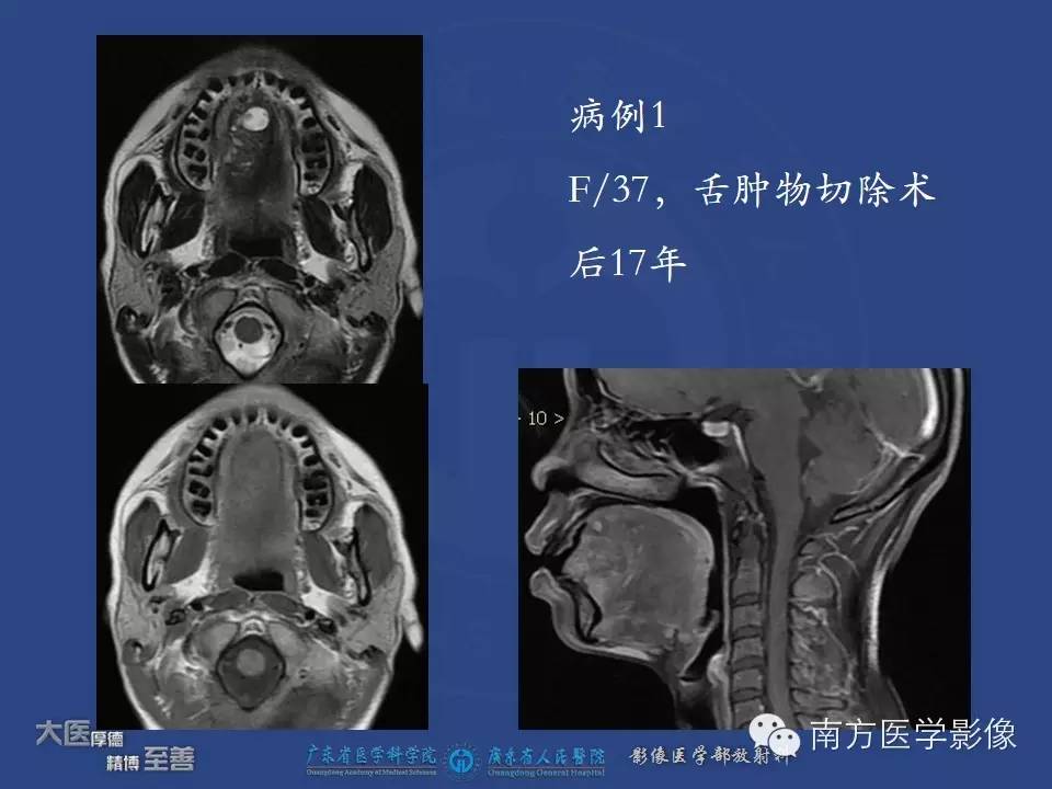 影像PPT - 【PPT】舌良、恶性肿瘤MR鉴别诊断-2