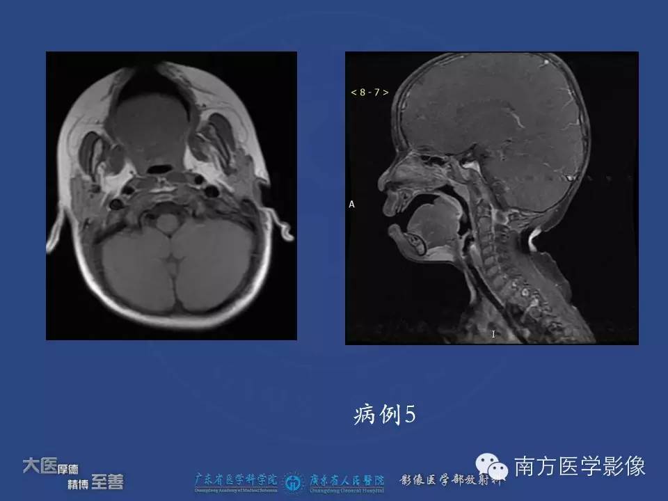 影像PPT - 【PPT】舌良、恶性肿瘤MR鉴别诊断-6