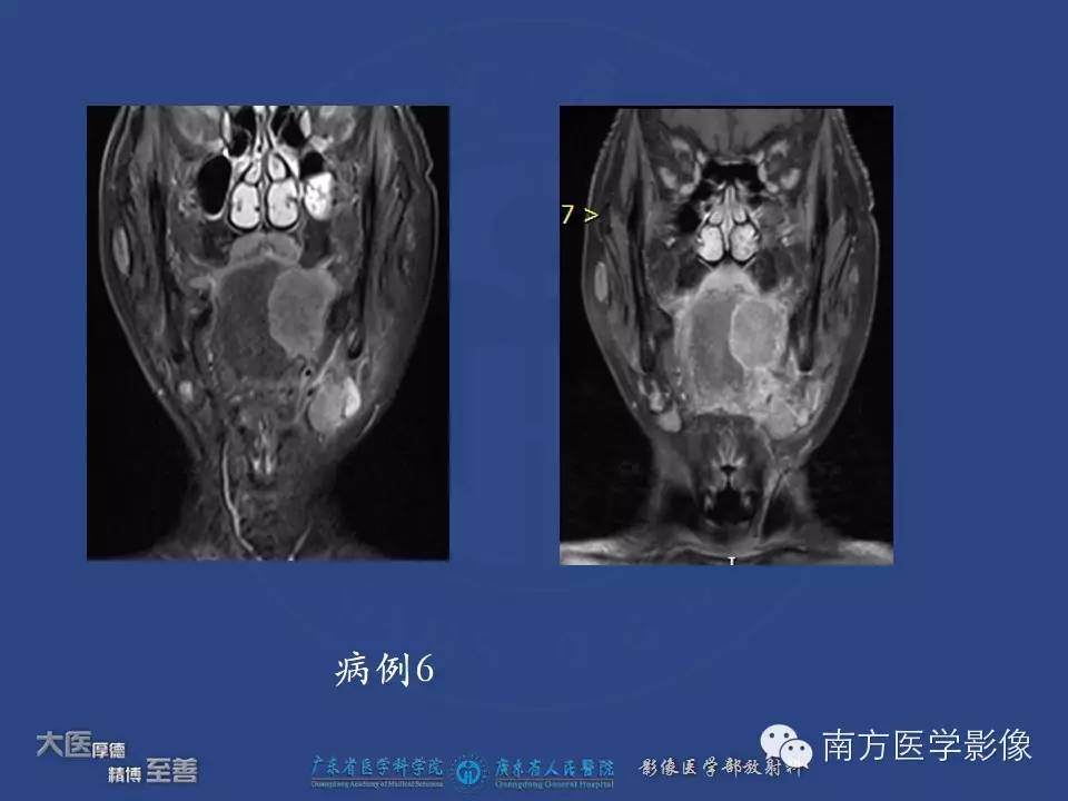 影像PPT - 【PPT】舌良、恶性肿瘤MR鉴别诊断-7