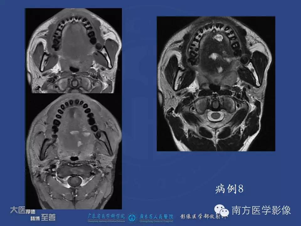 影像PPT - 【PPT】舌良、恶性肿瘤MR鉴别诊断-9