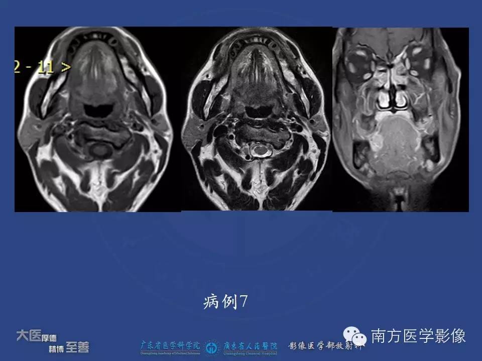 影像PPT - 【PPT】舌良、恶性肿瘤MR鉴别诊断-8