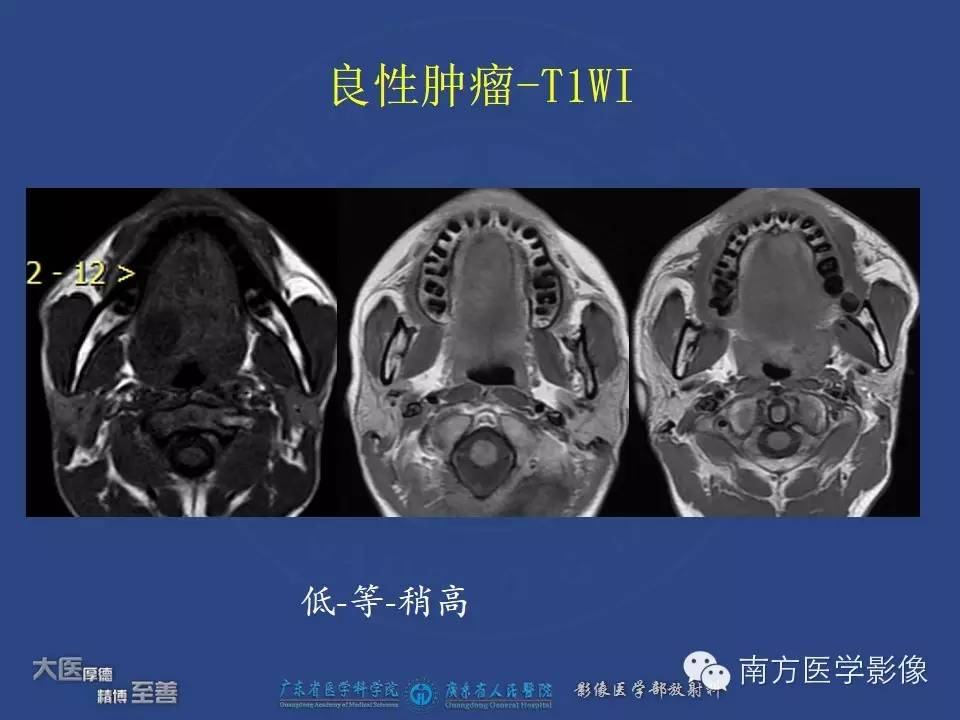 影像PPT - 【PPT】舌良、恶性肿瘤MR鉴别诊断-19