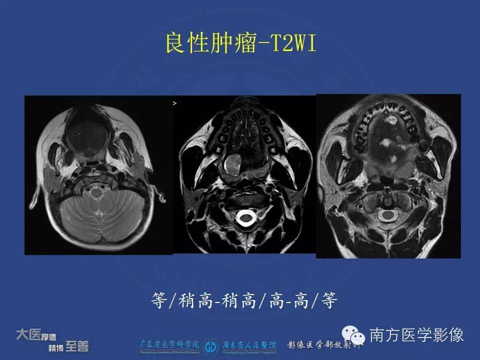 影像PPT - 【PPT】舌良、恶性肿瘤MR鉴别诊断-20