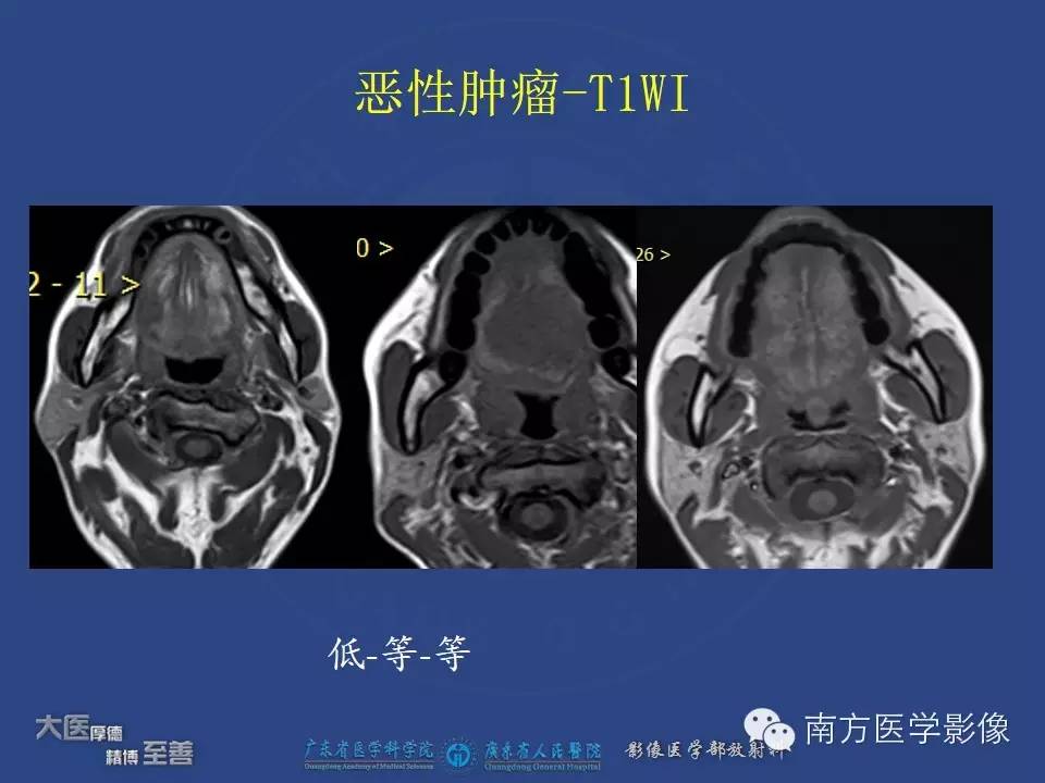 影像PPT - 【PPT】舌良、恶性肿瘤MR鉴别诊断-21