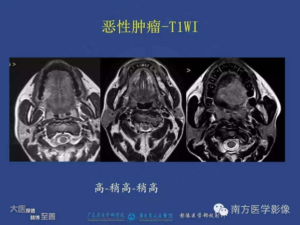 影像PPT - 【PPT】舌良、恶性肿瘤MR鉴别诊断-22