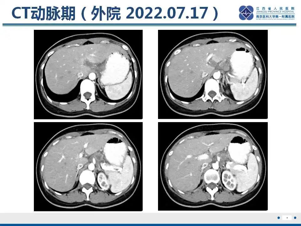 影像PPT - 【PPT】原发灶不明转移癌-5
