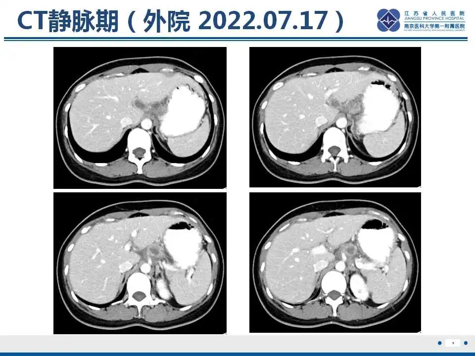 影像PPT - 【PPT】原发灶不明转移癌-6