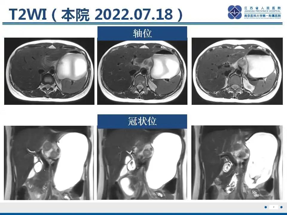 影像PPT - 【PPT】原发灶不明转移癌-8