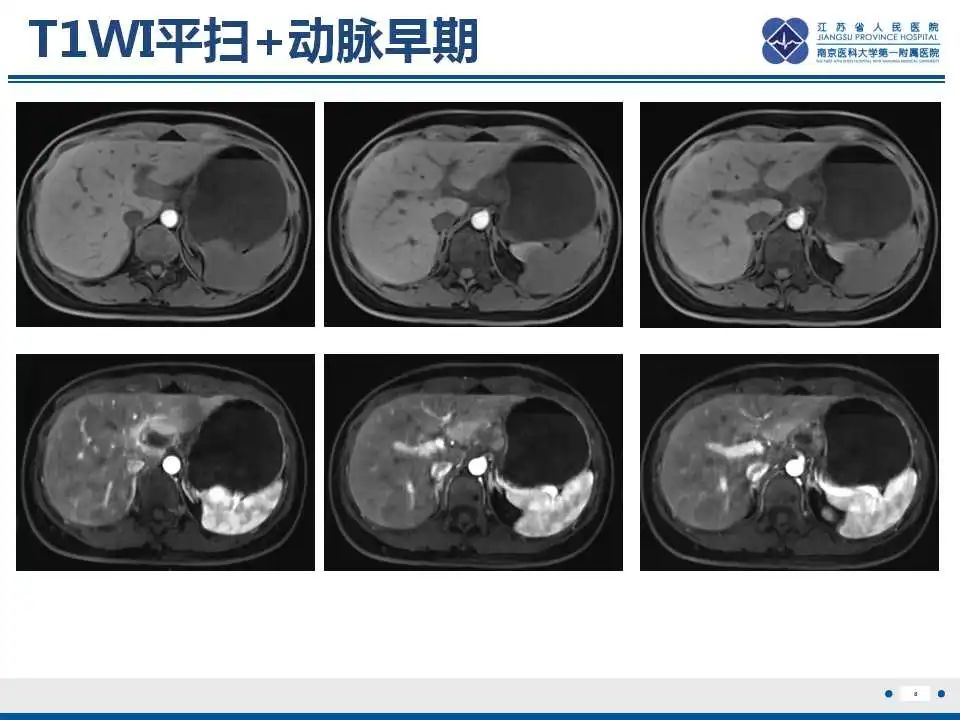 影像PPT - 【PPT】原发灶不明转移癌-9