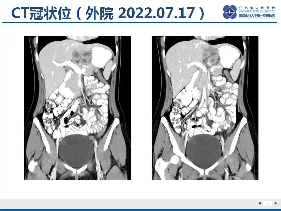 影像PPT - 【PPT】原发灶不明转移癌-7