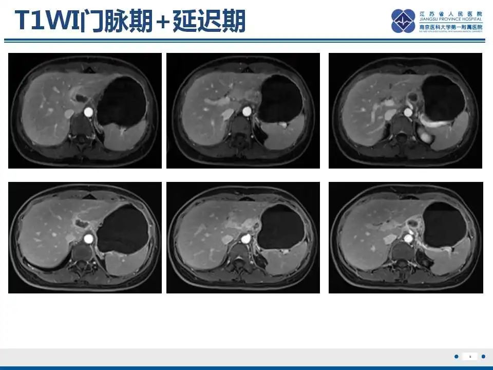 影像PPT - 【PPT】原发灶不明转移癌-10