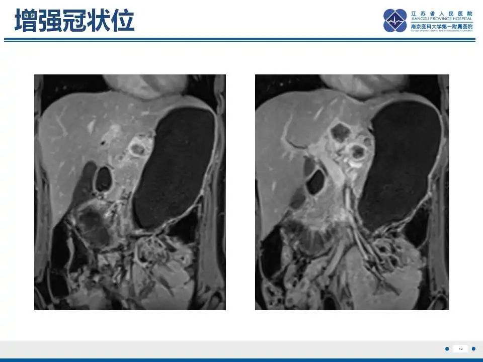影像PPT - 【PPT】原发灶不明转移癌-11