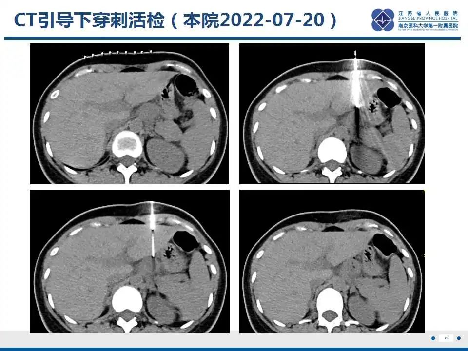 影像PPT - 【PPT】原发灶不明转移癌-24