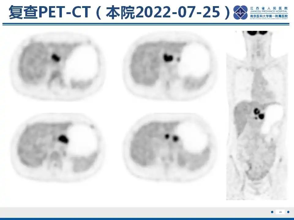 影像PPT - 【PPT】原发灶不明转移癌-30