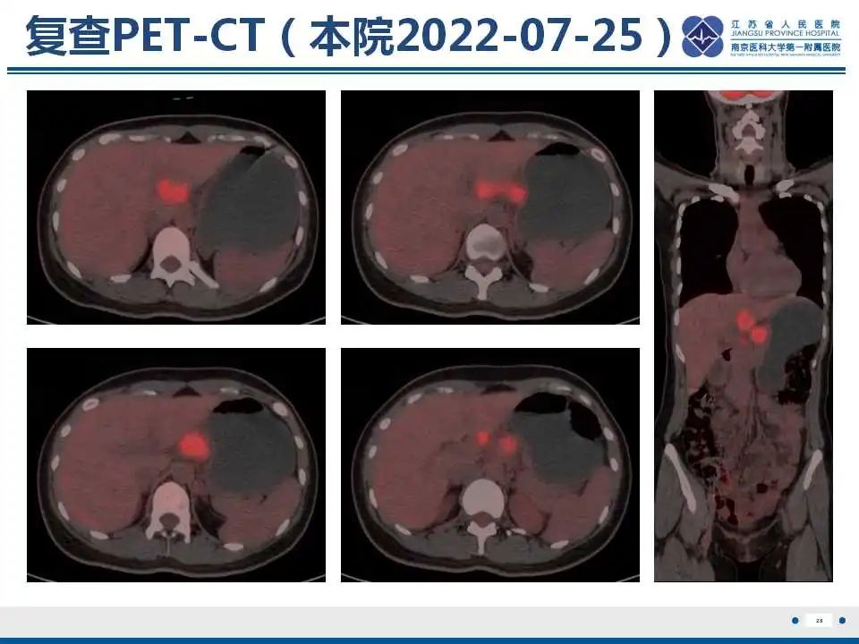 影像PPT - 【PPT】原发灶不明转移癌-29