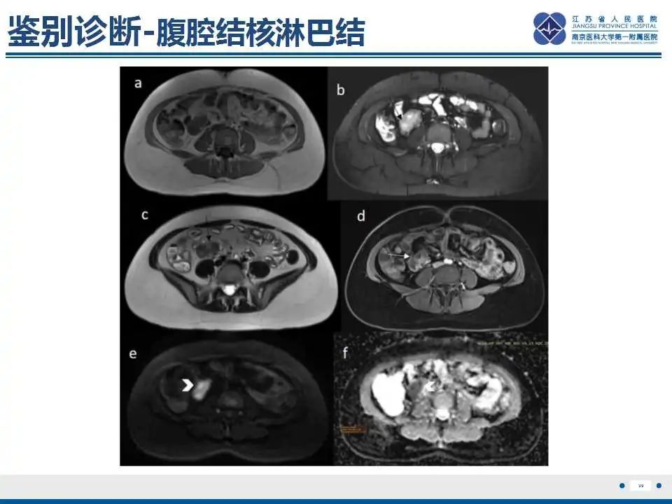 影像PPT - 【PPT】原发灶不明转移癌-40