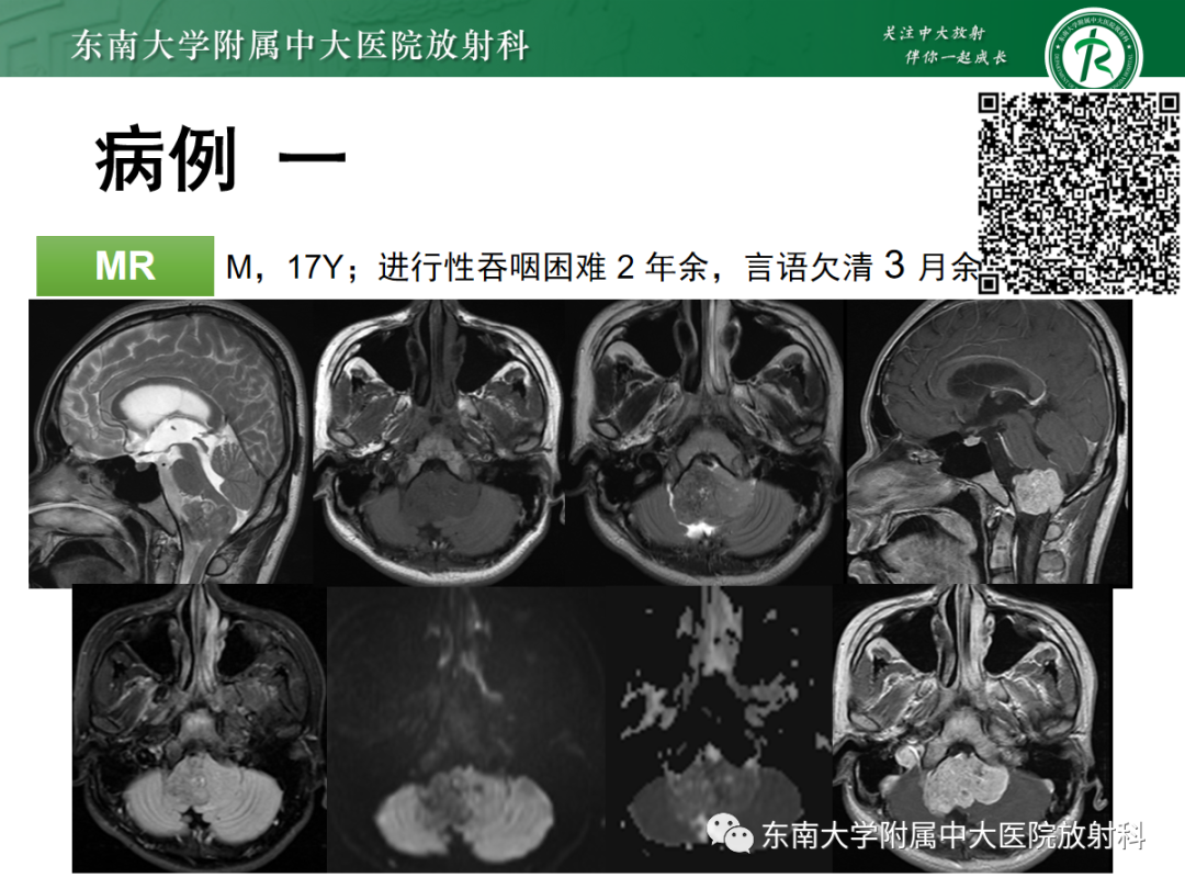 影像PPT - 【PPT】颅颈交界区占位病例随诊-1