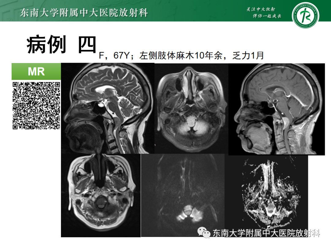 影像PPT - 【PPT】颅颈交界区占位病例随诊-4