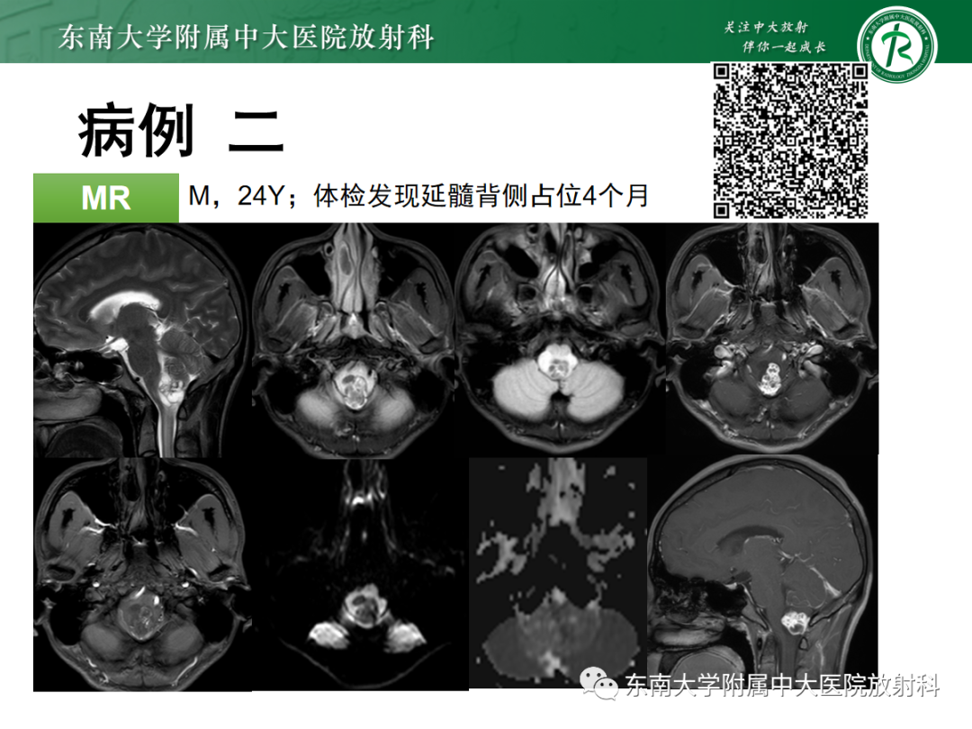 影像PPT - 【PPT】颅颈交界区占位病例随诊-2