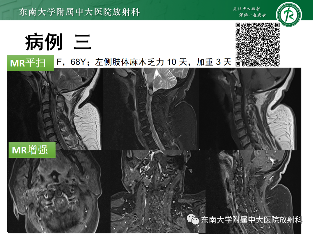 影像PPT - 【PPT】颅颈交界区占位病例随诊-3