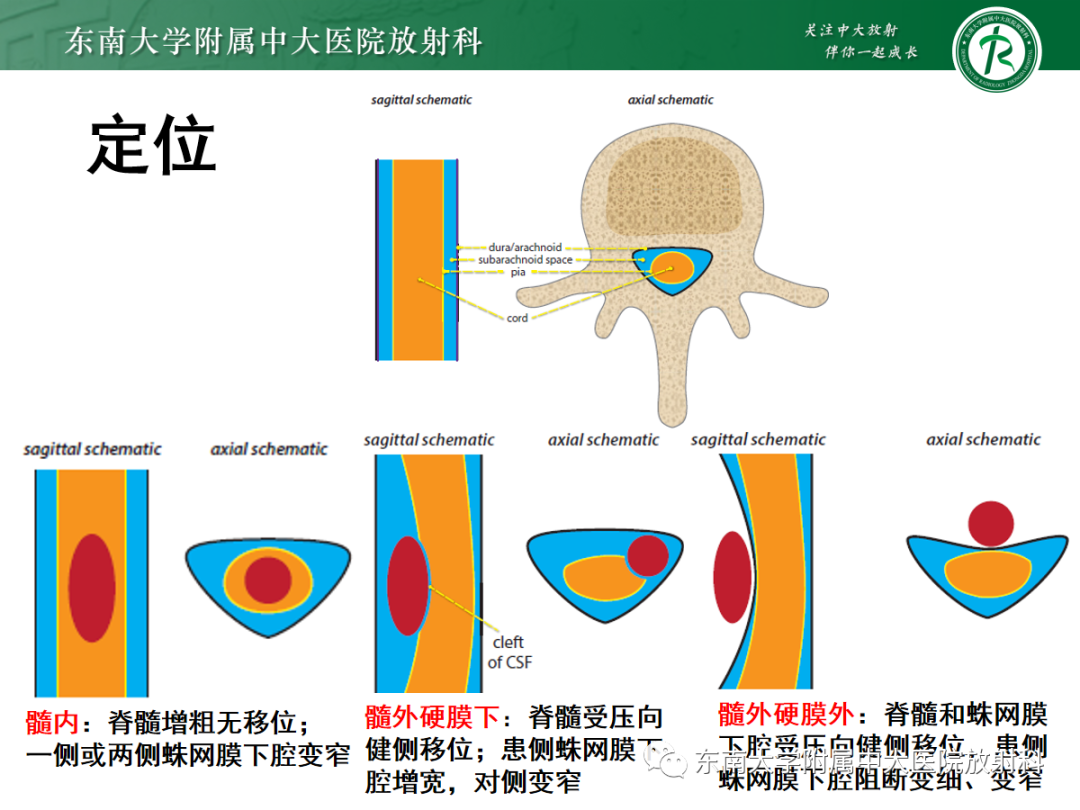 影像PPT - 【PPT】颅颈交界区占位病例随诊-14