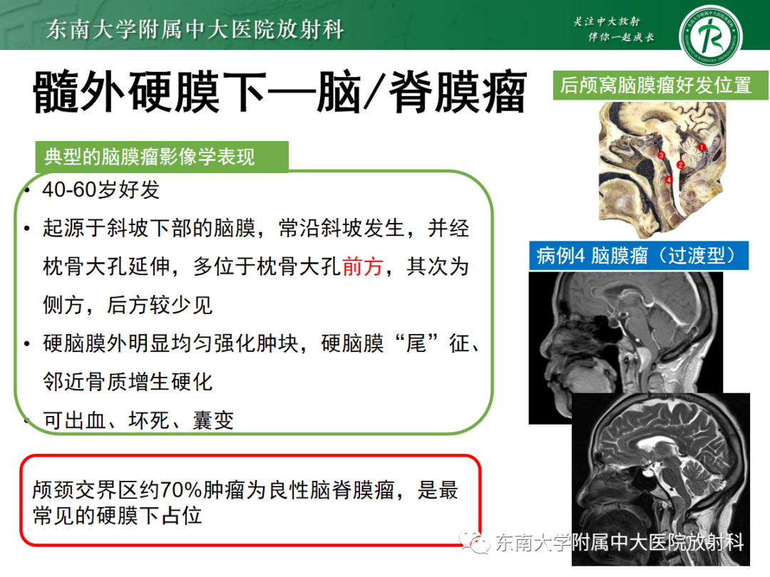 影像PPT - 【PPT】颅颈交界区占位病例随诊-16