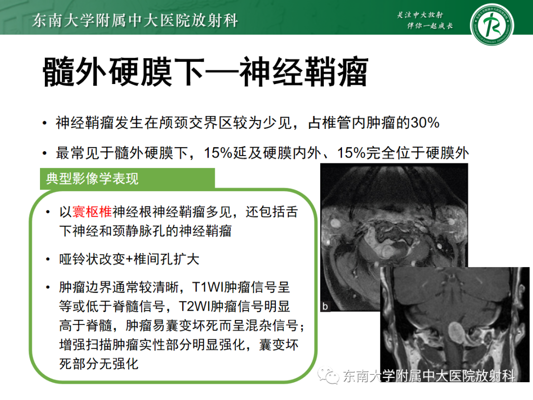 影像PPT - 【PPT】颅颈交界区占位病例随诊-18