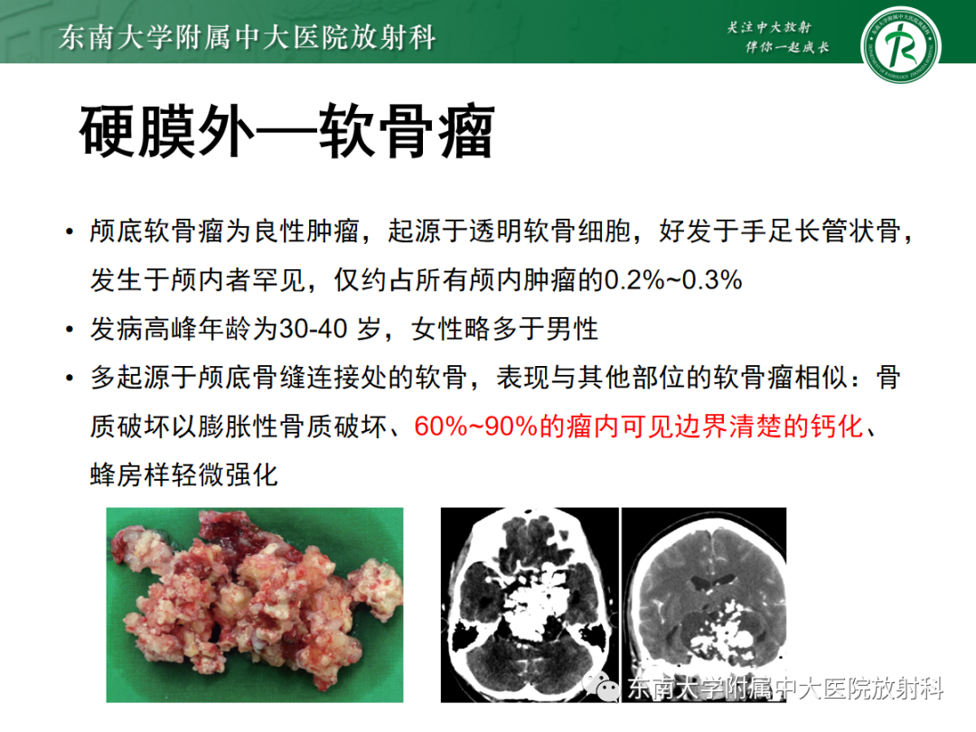 影像PPT - 【PPT】颅颈交界区占位病例随诊-19