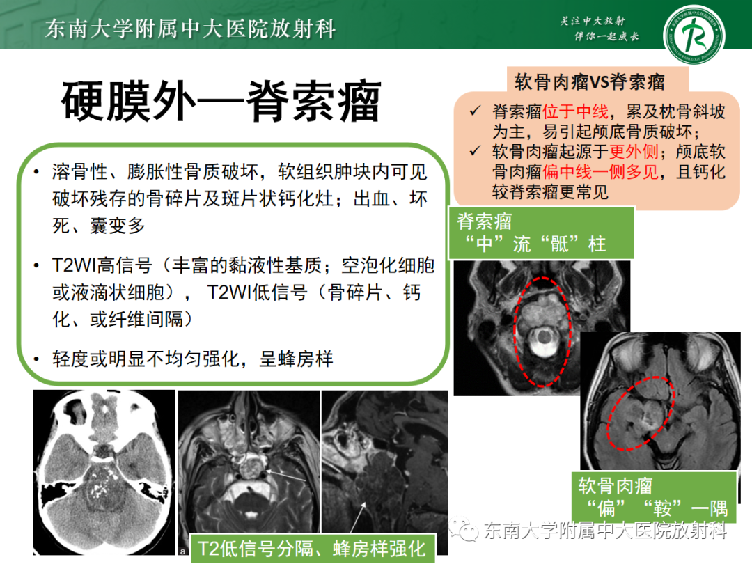 影像PPT - 【PPT】颅颈交界区占位病例随诊-24