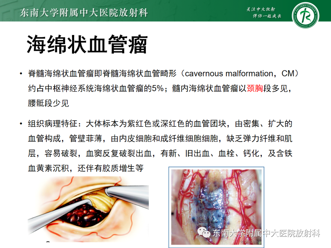 影像PPT - 【PPT】颅颈交界区占位病例随诊-27