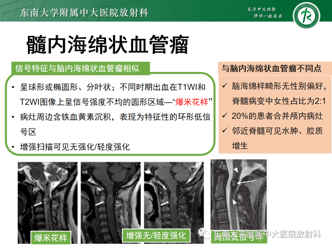 影像PPT - 【PPT】颅颈交界区占位病例随诊-28