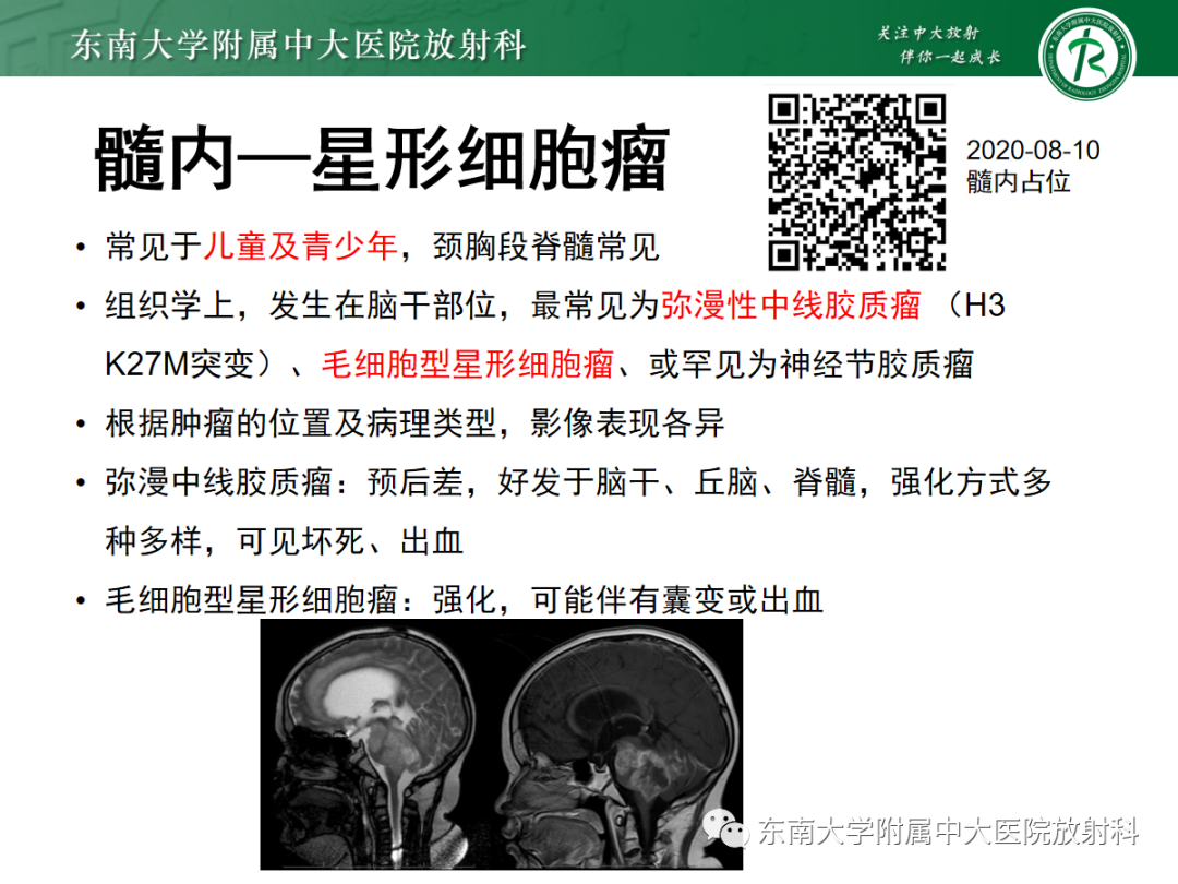 影像PPT - 【PPT】颅颈交界区占位病例随诊-30