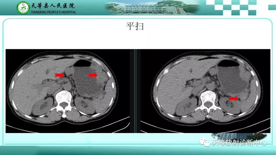 影像PPT - 【PPT】胃淋巴瘤-6